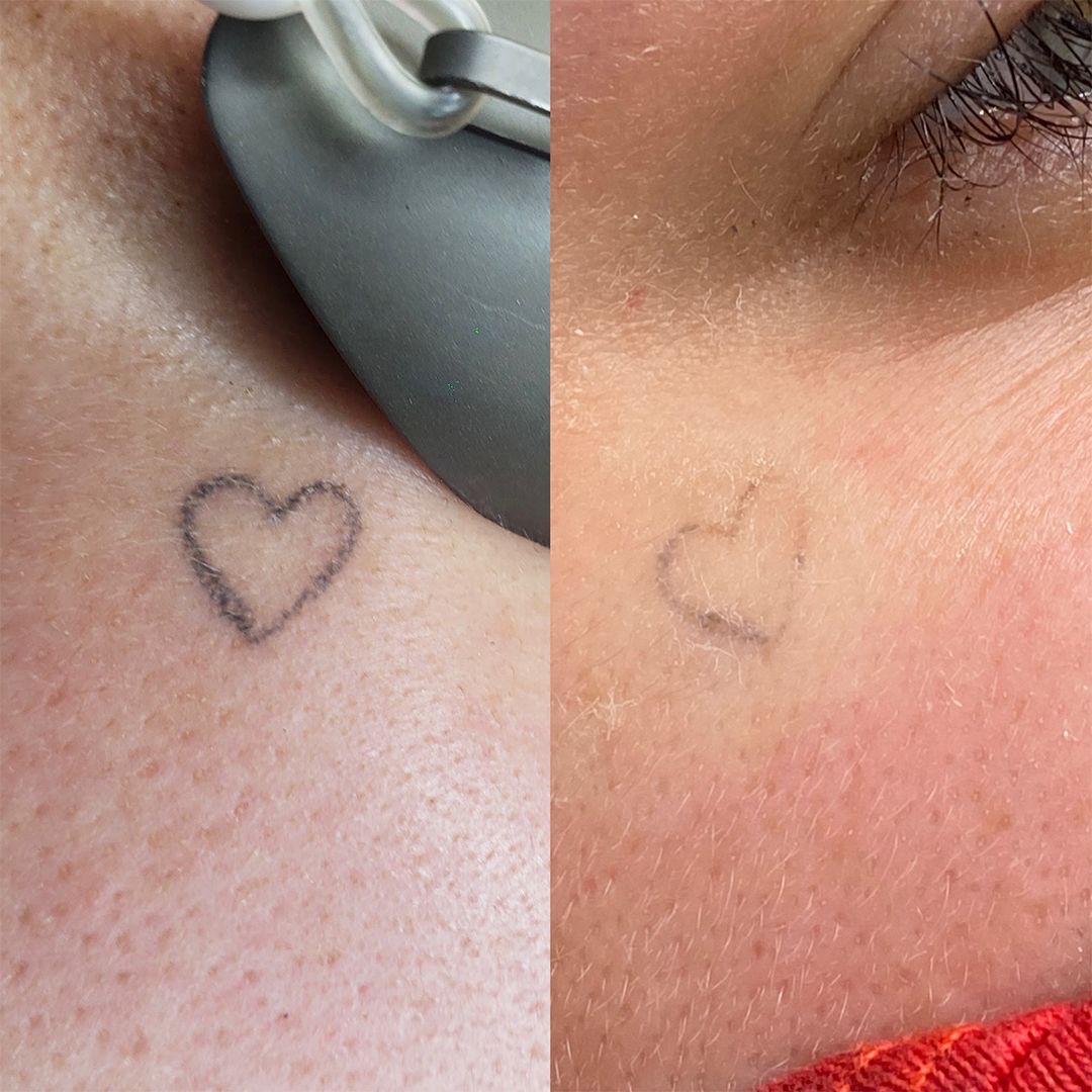 Comparativa de trabajo de remoción de tatuaje